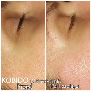 KOBIDO z algami Seaweex na twarz